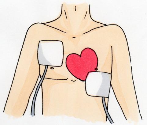 人間の胸に貼られた2つのパッドが赤い心臓を挟んでおり、AEDの正しい電極パッドの装着位置を示しているイラスト